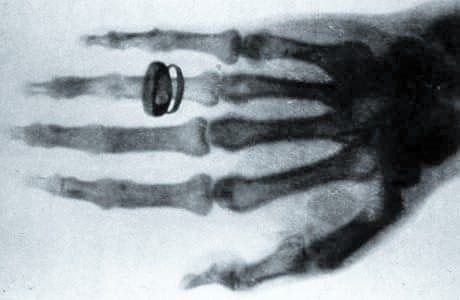 ' X-Ray ' ' Xray ' ' X-Ray of hand ' ' X-Ray of fingures 'X-Ray
